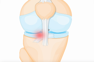 반월상연골파열